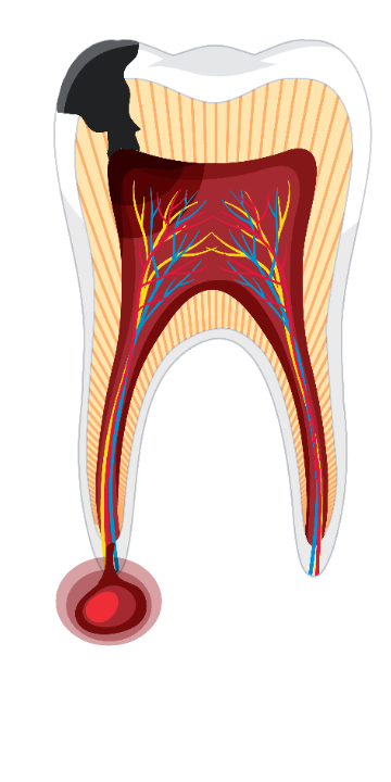 Gyökércsúcs gyulladás