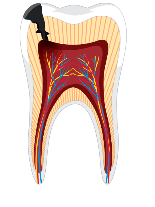 Fogbélgyulladás (pulpa gyulladás)