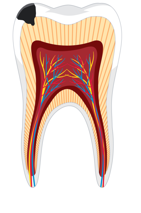 Repedt vagy letört fog