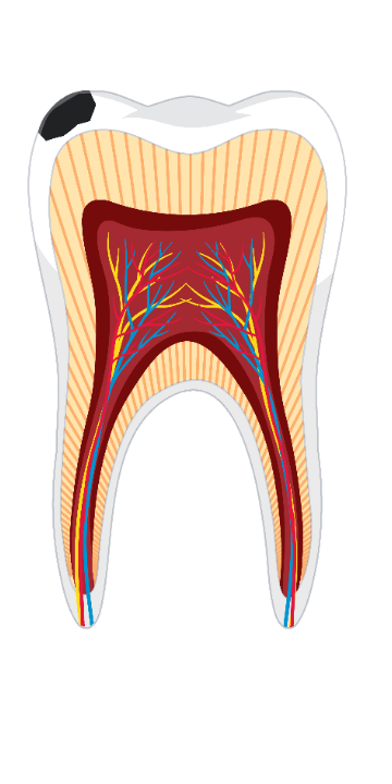 Fogszuvasodás – vagyis a lyukas fog