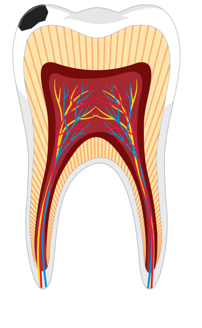 Fogfájás - fogszuvasodás