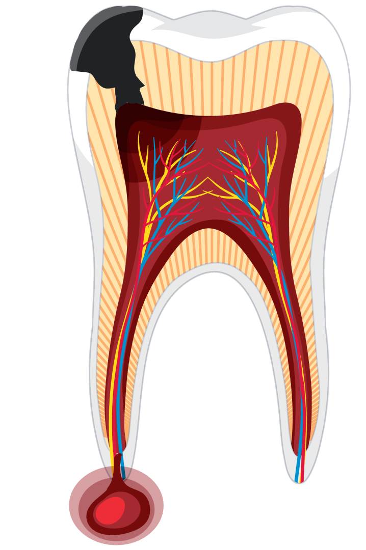 Gyökércsúcs gyulladás